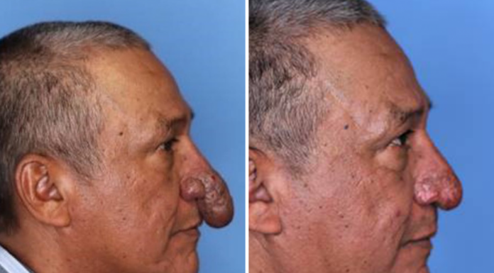 Nos Estados Unidos, homem com condição rara ganha ‘nariz novo’ para o Natal